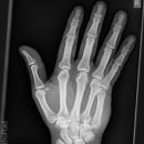 Reversed Bennett-Fraktur