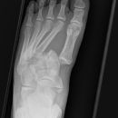 Lisfranc Luxationsfraktur