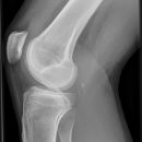 Tibiakopffraktur (nicht disloziert)