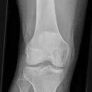 Tibiakopffraktur (nicht disloziert)