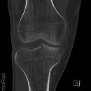 Tibiakopffraktur (nicht disloziert)