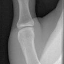 Bennett Fraktur mit geringer Dislokation