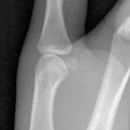 Bennett Fraktur mit geringer Dislokation