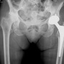 Coxarthrose