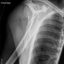 Dislozierte subcapitale Fraktur mit Tbc majus