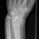 distale Radius-Ulnafraktur mit Palmarabkippung