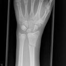 distale Radiusfraktur