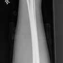 distale Radiusfraktur