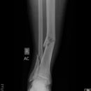 distaler Unterschenkelschaft