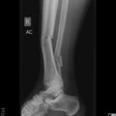 distaler Unterschenkelschaft