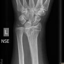 distaler Radiustrümmer Frykman VIII