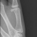 Endgelenksluxation Daumen