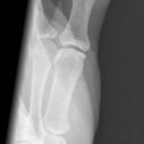 Endgelenksluxation Daumen