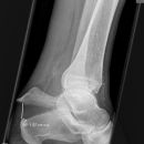 Entenschnabelfraktur