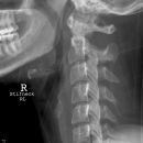 Foramen arcuale bzw Kimmerle Anomalie