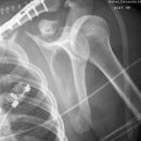 Fraktur Coracoid und Ala scapulae