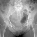 Fraktur Ramus pubis sup. und inf.