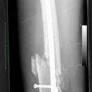 Fraktur Osteosynthese