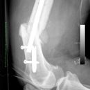 Fraktur Osteosynthese