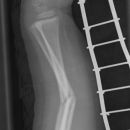 Unterarmschaft Fraktur