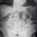 Ileus