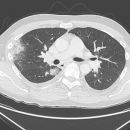 Infarktpneumonie bei Trikuspidalklappenendokarditis