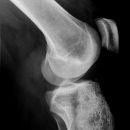 Intraossäres Hämangiom