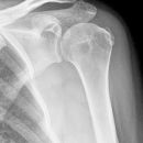 Kalkdepotinsertion Suprascapularis