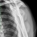 Kalkdepotinsertion Suprascapularis