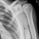 Knöcherner Supraspinatussehnenausriss