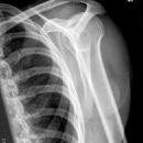 Knöcherner Supraspinatussehnenausriss