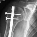 Lockerungszeichen Schulter