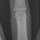 Mittelgliedbasisfraktur