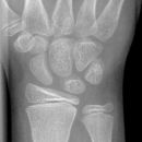 Nichtdislozierte Grünholzfraktur