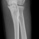 nicht dislozierte Radiusköpfchenfraktur