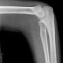 nicht dislozierte Radiusköpfchenfraktur