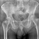 Nichtdislozierte Sitzbeinfraktur