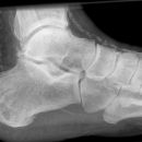 Osteomyelitis Calcaneus