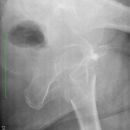 pertrochantäre Femurfraktur