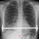 Pleuraabszess bei Trichterbrust OP