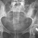 Sakroiliitis bei Bechterew