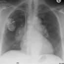 Sarkoidose Stadium I