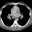 Sarkoidose Stadium II