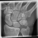 Scaphoid1.jpg