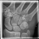 Scaphoid2.jpg