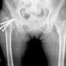 Sekundäre Dislokation