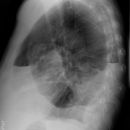 Seropneumothorax 2 Ebenen