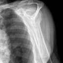 Subcapitale Fraktur und Tuberculum majus