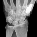 TEP Daumensattelgelenk