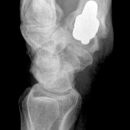 TEP Daumensattelgelenk